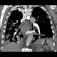 Pachypleuritis after talc pleurodesis: CT - Computed tomography